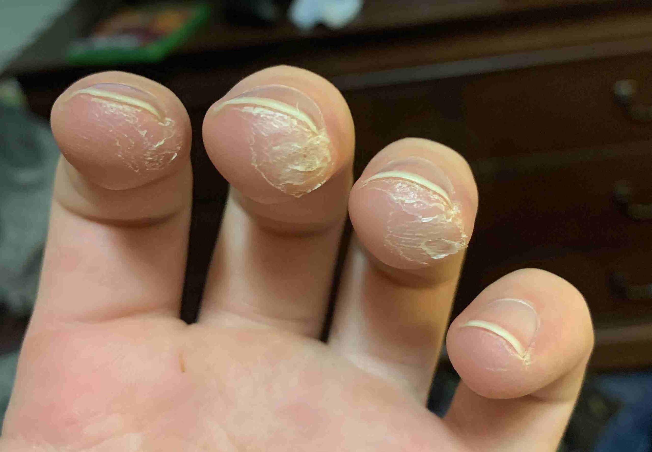 guitar calluses hard skin